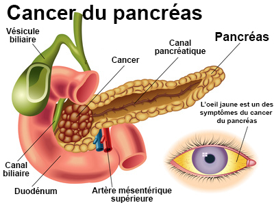 Cancer du pancréas : symptômes, traitement, définition ...