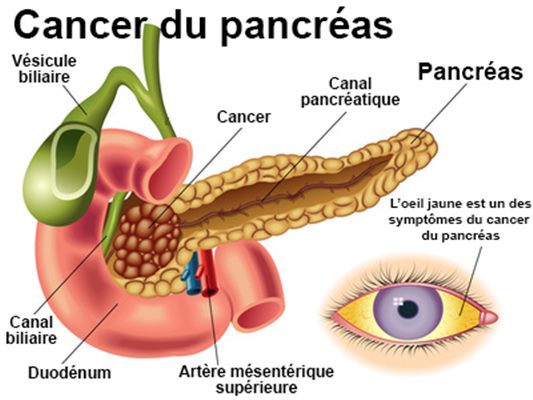 Cancer du pancréas