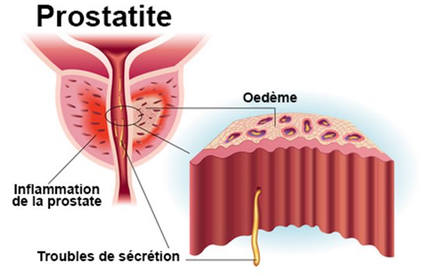 prostatite aiguë symptômes