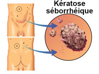 kératose séborrhéique