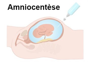 amniocentèse