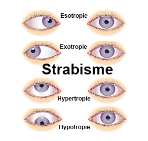 Strabisme Symptomes Traitement Definition Docteurclic Com Strabisme Symptomes Traitement Definition Docteurclic Com