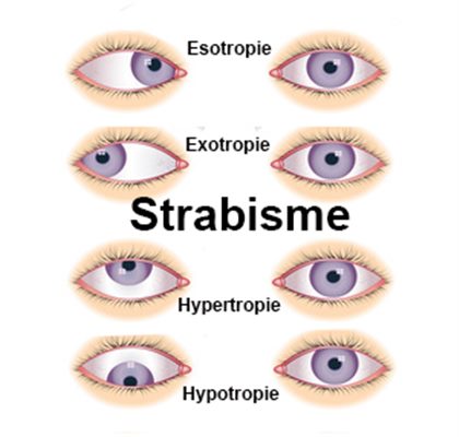 Strabisme