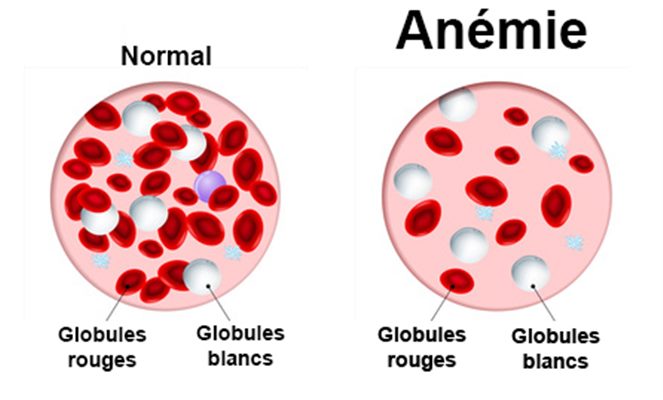 symptomes anemie