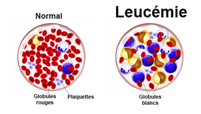 Leucémie : symptômes, traitement, définition - docteurclic.com