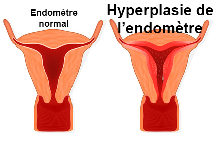 Hyperplasie de l'endomètre : symptômes, traitement, définition ...