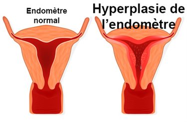 hyperplasie de l'endomètre