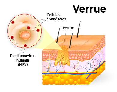 Hpv verrue genitale. Papillomavirus verrues genitales