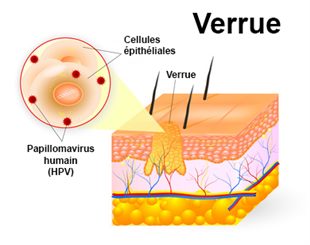 Condylome : symptômes, traitement, définition - docteurclic.com