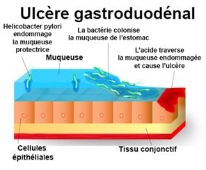 ulcère gastroduodénal