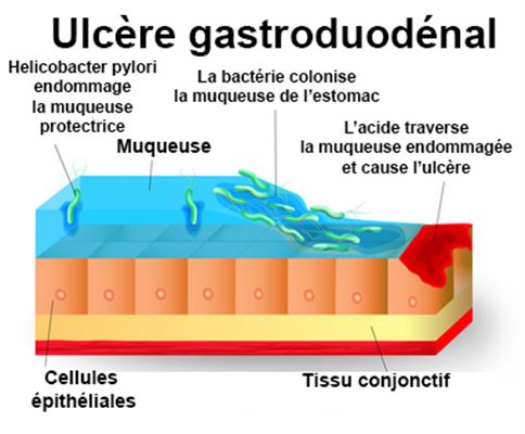 Ulcère gastro-duodénal