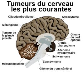 tumeurs du cerveau