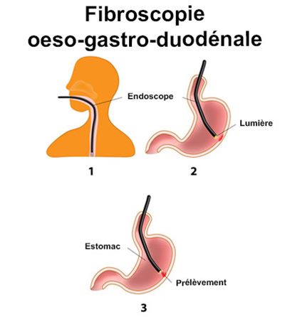 Fibroscopie oeso-gastro-duodénale