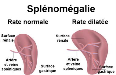 splénomégalie