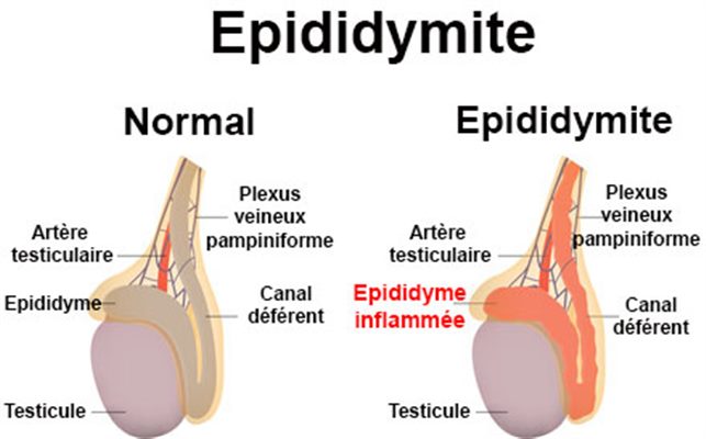 Épididymite : symptômes, traitement, définition 