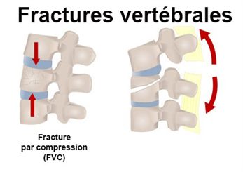 fracture vertébrale