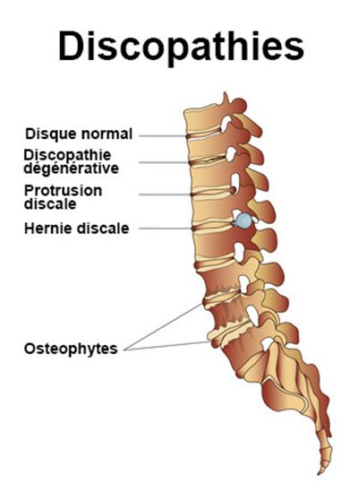 Discopathie : symptômes, traitement, définition - docteurclic.com