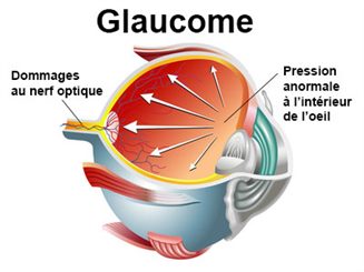 glaucome