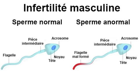 infertilité masculine