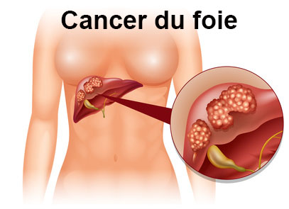 Anatomie du foie - Cancer du foie
