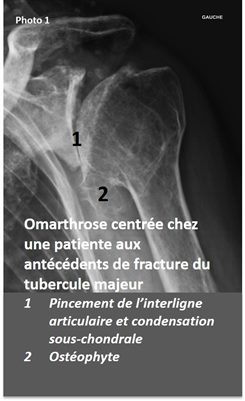 Photo1 Omarthrose centrée