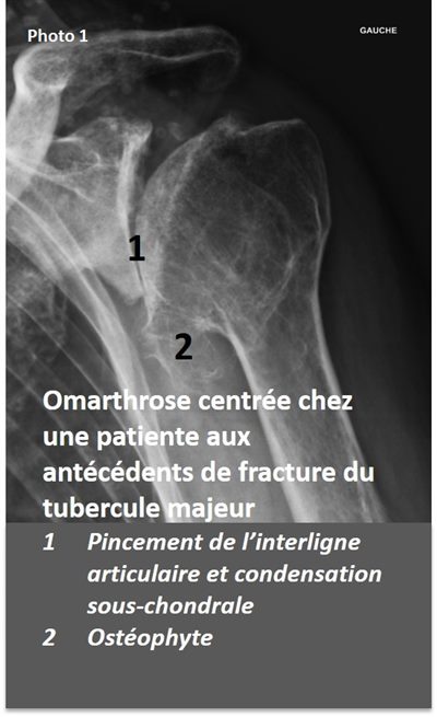 Arthrose de l'épaule: omarthrose