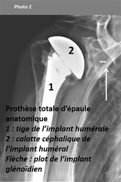 Photo 2 Prothèse totale d'épaule