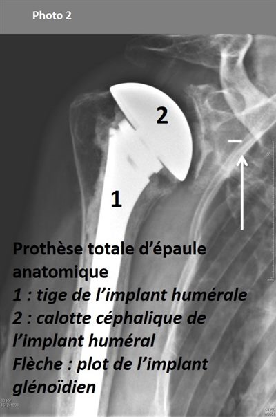 Prothèses de l'épaule