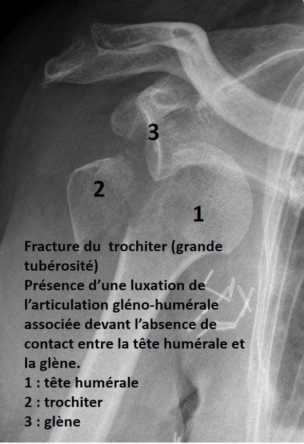 Fracture épaule extrémité proximale de l'humérus : définition ...