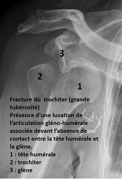 Photo 1 Fracture du  trochiter