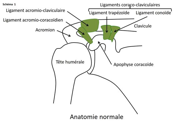 Disjonction acromio-claviculaire