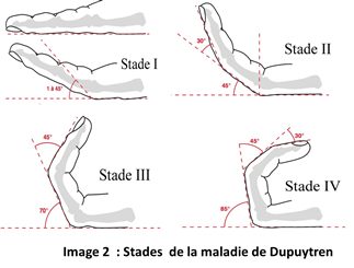 Image 2 Stades de la maladie de Dupuytren