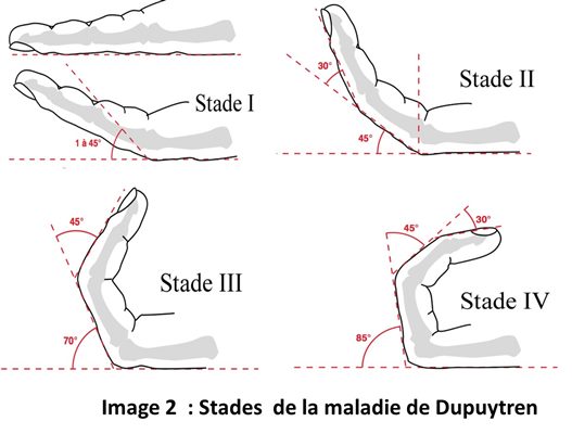 Chirurgie de la maladie de Dupuytren