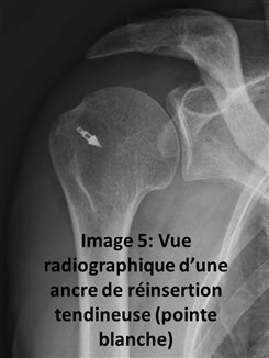 Vue d'une ancre de réinsertion tendineuse