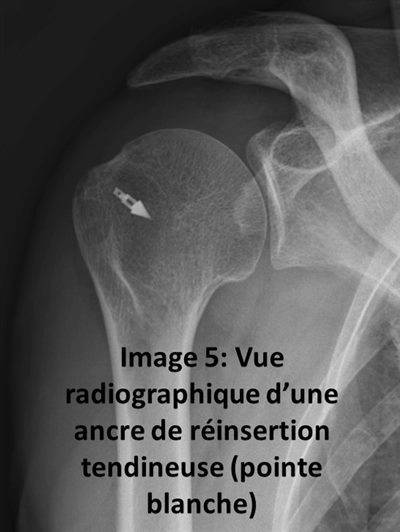 Arthroscopie de l'épaule