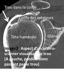 Arthroscanner visualisant un trou dans la coiffe