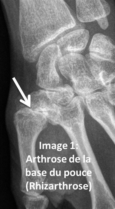 La rhizarthrose (arthrose du pouce)