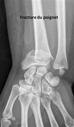 Fracture du poignet 
