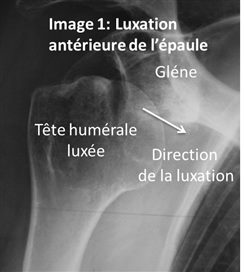 Luxation  antérieure de l’épaule 