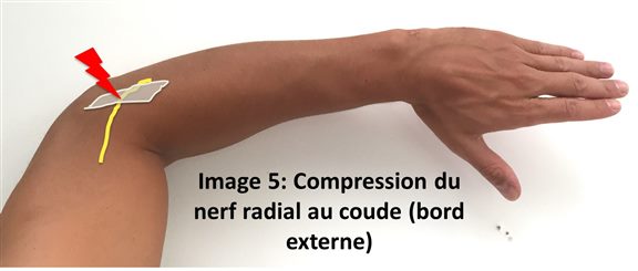 Compression du nerf radial au coude (bord externe)