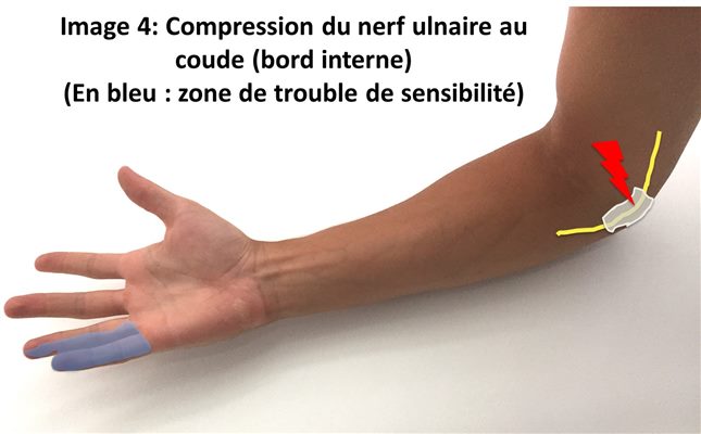 Compression du nerf ulnaire au coude