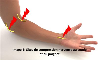 Compression du nerf radial au : -