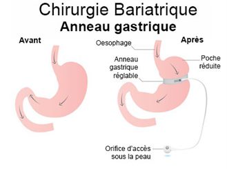 Anneau gastrique