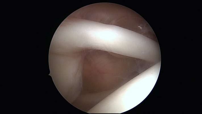 Chirurgie arthroscopique du tendon du biceps et de l'acromion