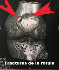 Fracture rotule